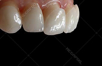 Dental ceramic veneers on the black background