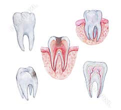 Schemes of  healthy tooth anatomy in a cross section and cavity