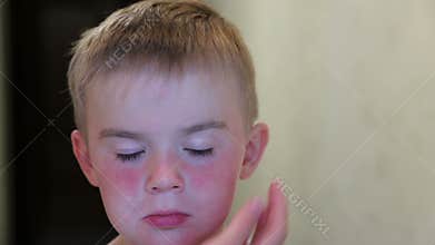 Allergy to the sun on the baby's face. Red spots under the child's eyes. Mother touched her face. The child is sad