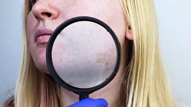 Post-acne under a magnifying glass. Skin with acne scars. Woman at the appointment with a dermatologist