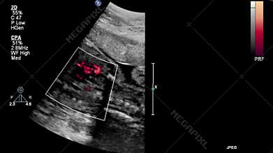 Ultrasound examination of the fetal heart.