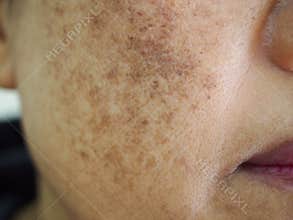 Melasma on face