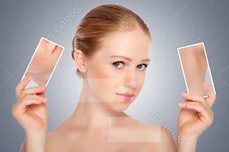 Concept skincare . Skin of beauty young woman with acne