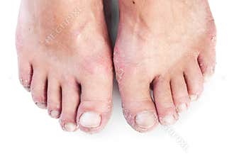 Two male feet with eczema isolated on white