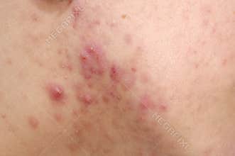 Acne problems