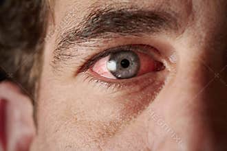 Bloodshot eye