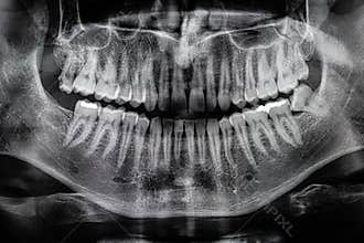 Orthopantomography, OPG X-ray DR digital wisdom teeth