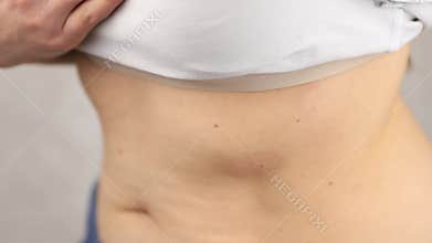 spot of erythema migrans in lyme disease borreliosis on female stomach