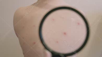 Close up observation of skin featuring chickenpox bumps under a magnifying glass lens