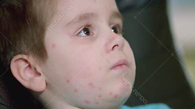 A young child exhibiting skin rash chickenpox symptoms that raise concerns requiring attention