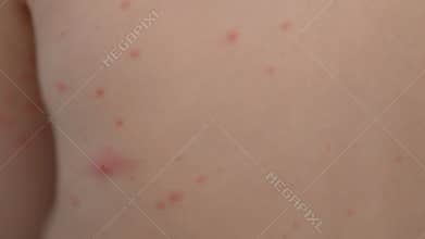 Closeup image of skin irritations chickenpox and bumps present on the human body for examination