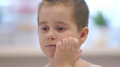 Chickenpox. A child with skin concerns is seen in a bright environment, showcasing their innocence