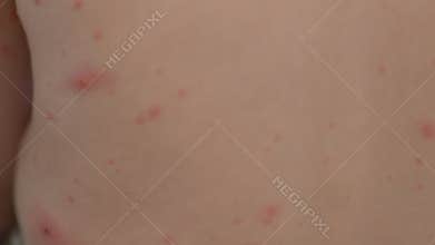 Detailed closeup view of skin revealing a prominent rash chickenpox or possible allergic reaction