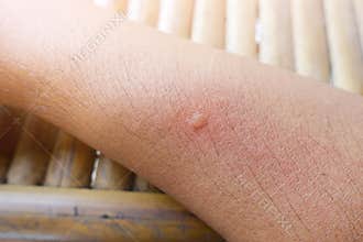 Allergy of mosquito bites on arm