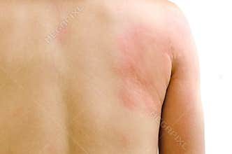 Urticaria