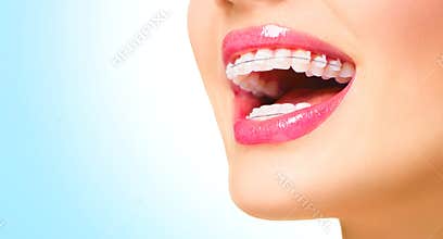 Woman smiling with ceramic braces on teeth