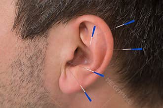 Acupuncture needles on ear