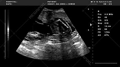 Ultrasound black and white version
