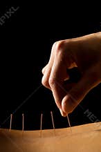 Acupuncture