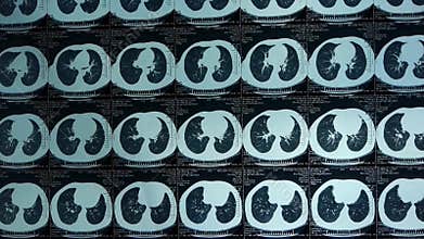 Moving lung pet-ct scan,medical X-ray.