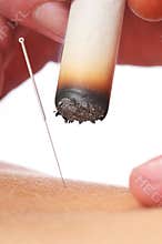 Acupuncture and moxer