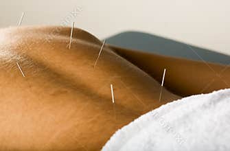 Male acupuncture patient