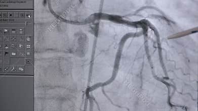 X-ray real heart beating in action.