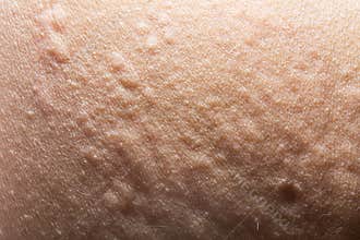 Urticaria or allergy rash