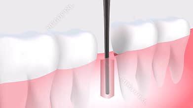 Tooth implant