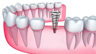 Implant is embedded in the gum