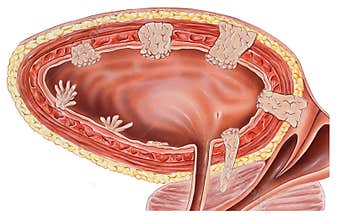 Urinary Bladder & Wall - Cancer