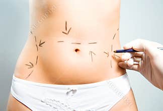 Drawing marks for abdominal plastic surgery
