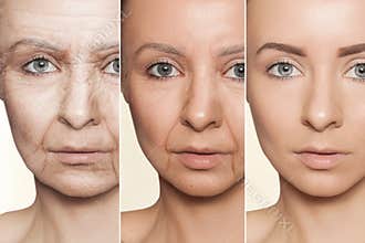 Anti-aging procedures on caucasian woman face